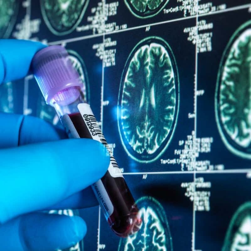 Blood checks for Alzheimer’s is also rolled out inside 5 years