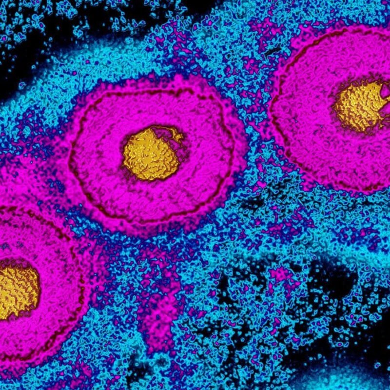 Genital herpes connected to speeded up mind shrinkage