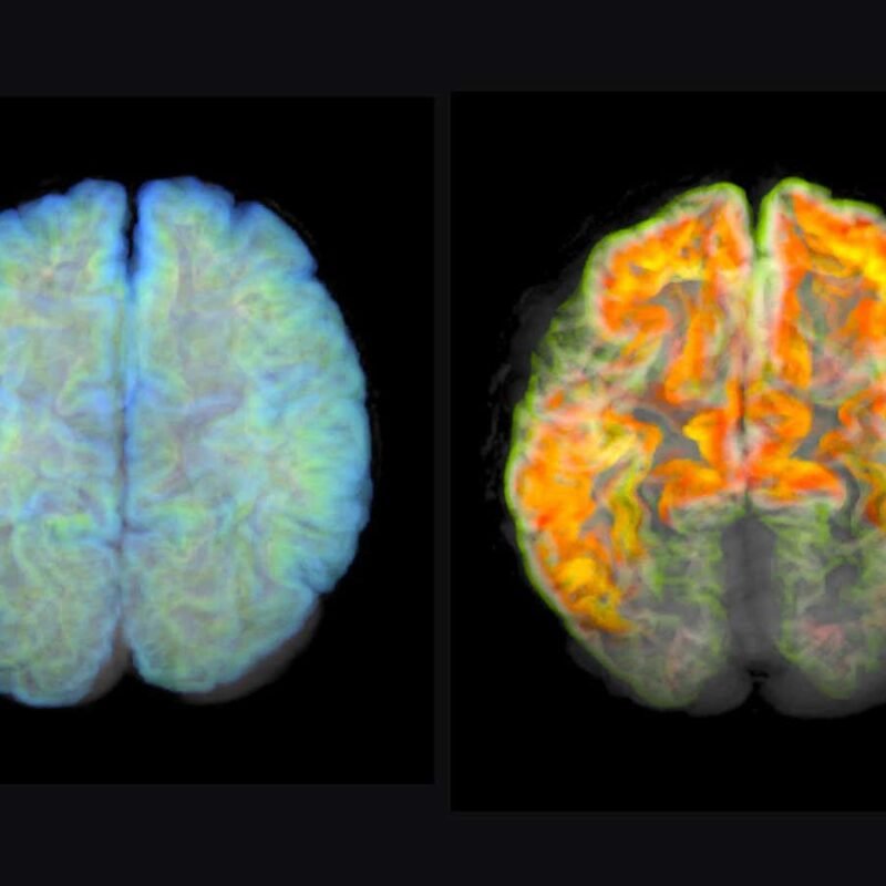 2023 noticed a wary hope for Alzheimer’s remedy however doubts stay 2023 noticed a wary hope for Alzheimer’s remedy however doubts stay