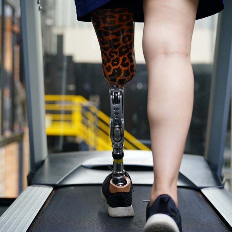 Spinal wire stimulator dramatically reduces phantom limb ache Spinal wire stimulator dramatically reduces phantom limb ache