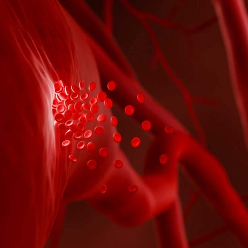 Mild haemophilia may add an extra year or two to someone’s life Mild haemophilia may add an extra year or two to someone’s life