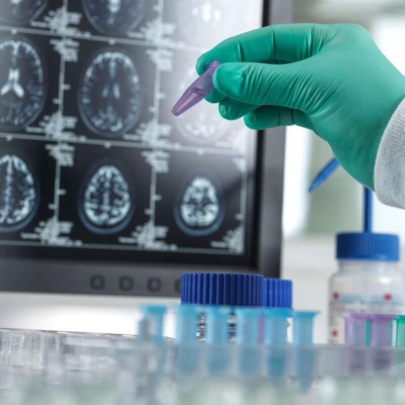 Contaminated hormone injections may have given five people Alzheimer’s