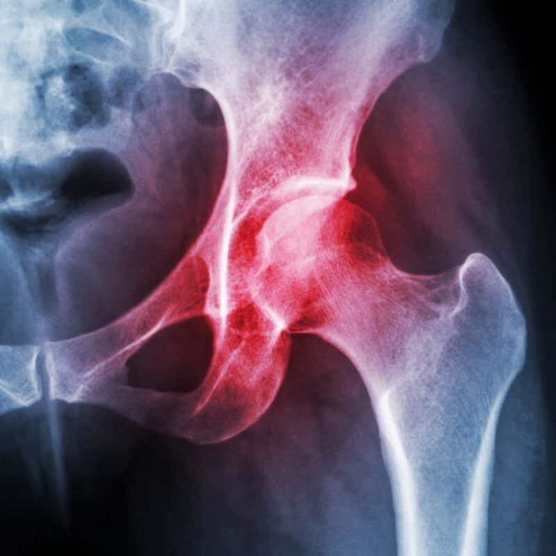 Injections of drug-filled nanoparticles may relieve arthritis pain Injections of drug-filled nanoparticles may relieve arthritis pain