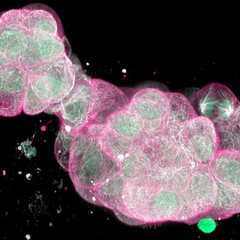 Testing drugs on mini-cancers in the lab may reveal best treatment