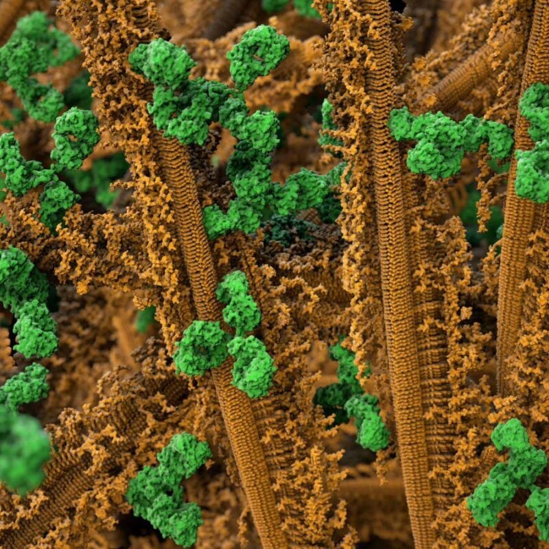 Parkinson’s disease progression slowed by antibody infusions