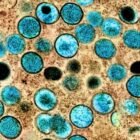 Dangerous mpox strain spreading in the Democratic Republic of the Congo