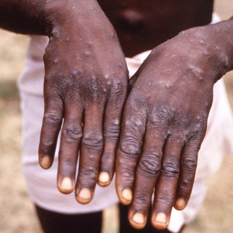 Does mpox cause lingering symptoms like long covid?