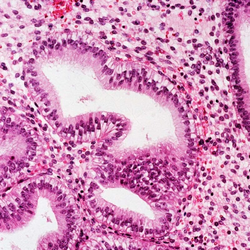 Most detailed map of uterine lining yields clues about endometriosis Most detailed map of uterine lining yields clues about endometriosis