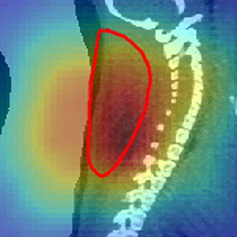 Radioactive ion beam could target tumours more precisely Radioactive ion beam could target tumours more precisely