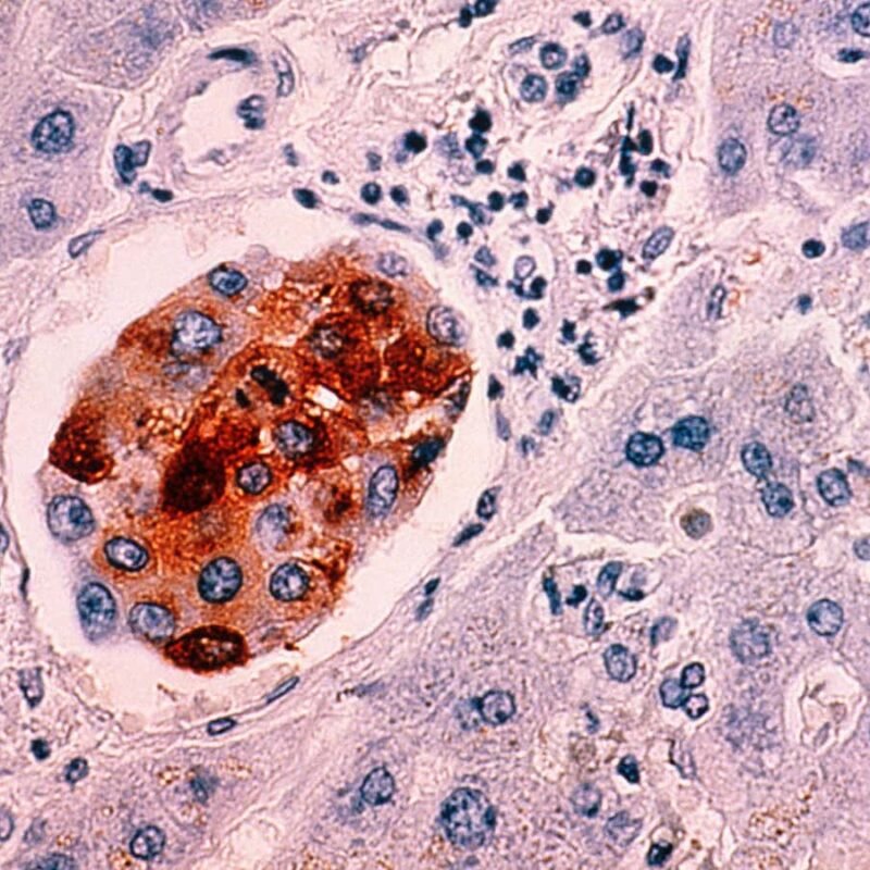 Cancer deaths expected to nearly double worldwide by 2050