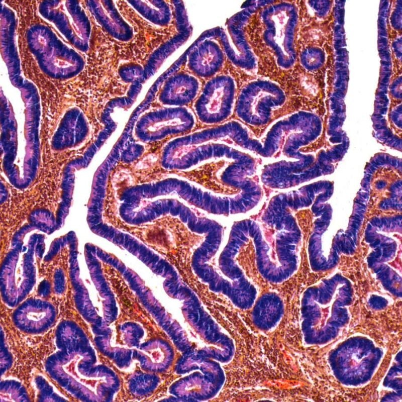 Bowel cancer is rising in younger people around the world